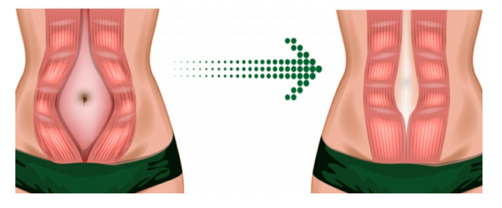 Diástasis Abdominal Perinium Entrenamiento Online